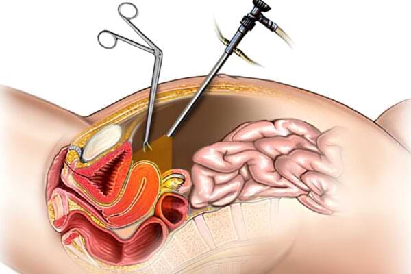 Surgeon explaining laparoscopic vs open surgery options at Prabhu Hospital