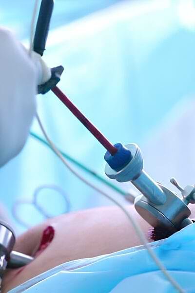 Benefits of 3D laparoscopic surgery over open surgery