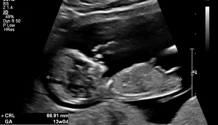 Sonography