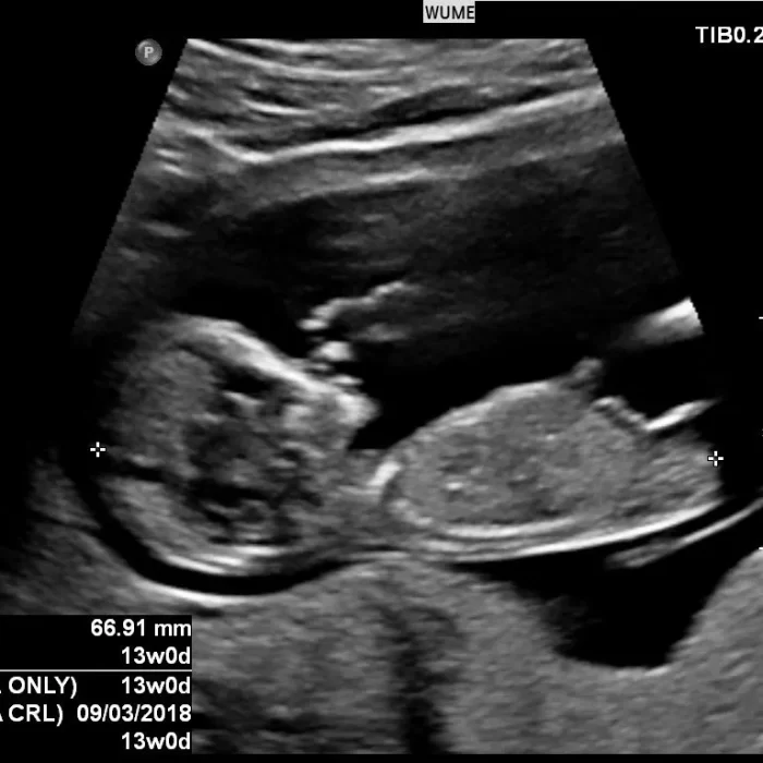 Sonography